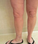 Varicose Veins