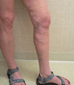 Varicose Veins