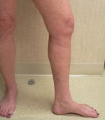 Varicose Veins