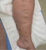 Varicose Veins