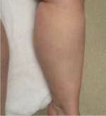 Varicose Veins