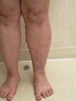 Varicose Veins