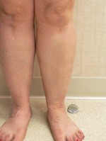 Varicose Veins