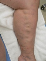 Varicose Veins