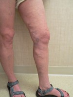 Varicose Veins