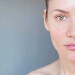 Female patient has red vessels on her face