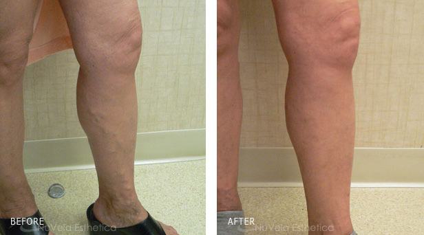 Bulging leg veins treated with ultrasound-guided foam Sclerotherapy by Dr. Dishakjian, the vein surgeon at Nu Vela in Los Angeles