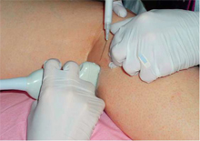 Injecting Foam for Foam Sclerotherapy