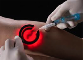 Transilluminated Sclerotherapy for spider vein removal