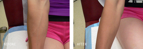 Hand Vein Sclerotherapy Removal Before and After Los Angeles