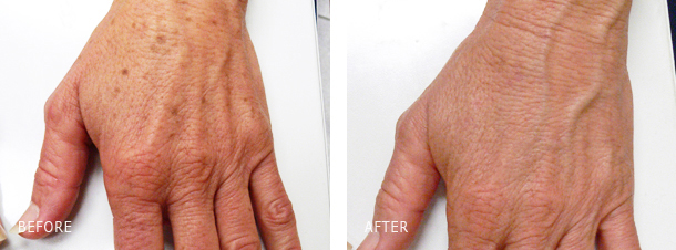 LASER REMOVAL OF SUN AND AGE SPOTS ON HANDS BEFORE AND AFTER LOS ANGELES