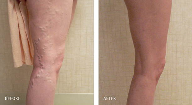 FOAM SCLEROTHERAPY FOR BULGING LEG VARICOSE VEIN REMOVAL