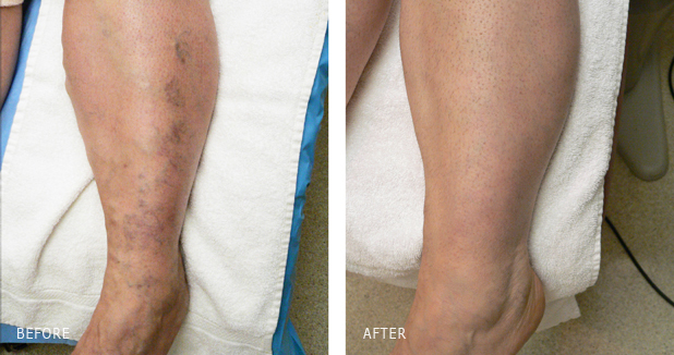 BEFORE/AFTER SCLEROTHERAPY OF LEG SPIDER VEINS