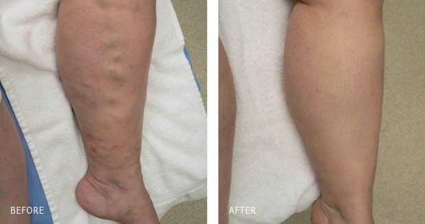 lEG SAPHENOUS VEIN ABLATED WITH VENEFIT AND BRANCH VEINS TREATED WITH FOAM SCLEROTHERAPY