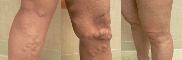 Forms of varicose veins