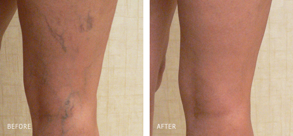 Sclerotherapy leg spider veins treatment by Dr. Dishakjian of Nu Vela in Los Angeles